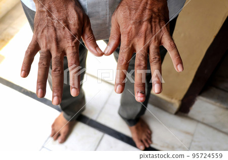 Fungus Infection on Nails Hand, Finger with onychomycosis. 95724559