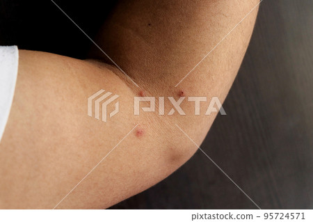 Allergy concept. Young man with pimples 95724571