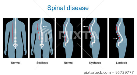 Normal spine and Spinal deformity from Scoliosis to Lordosis and Kyphosis. 95729777