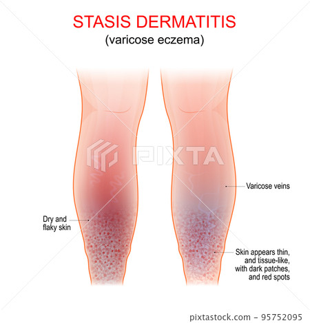 Varicose eczema. Symptoms of venous, gravitational or stasis dermatitis 95752095