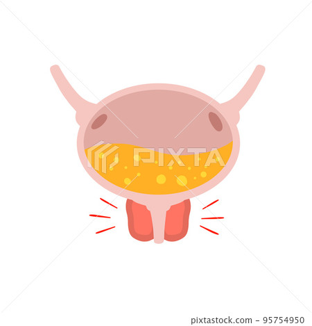 Inflammation of prostate. Scheme of health and bladder problems. Yellow urine. Concept of prostatitis. Flat cartoon Inflammation of prostate. Scheme of health and bladder problems. Yellow urine. Concept of prostatitis. Flat cartoon 95754950
