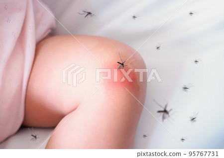 cute asian baby girl has rash and allergy on knee skin from mosquito bite and sucking blood cute asian baby girl has rash and allergy on knee skin from mosquito bite and sucking blood 95767731