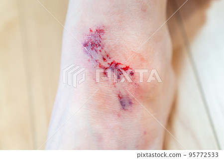 A picture of an injured leg. 95772533