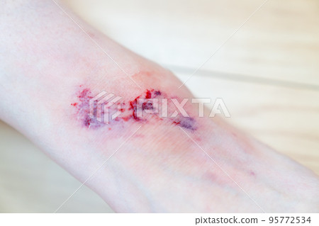 受傷腿的照片。 95772534