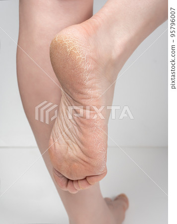 Closeup of dry skin of feet, sole with scales and cracks. Moisturizer and treatment cosmetic onto toes and heel, skincare cosmetic. rough skin on female feet on gray background 95796007