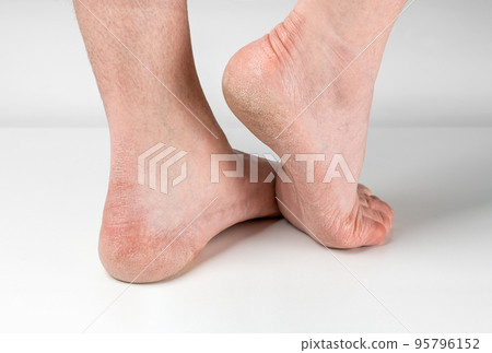 Dry and cracked soles of feet on gray background, man feet with dry heels, cracked skin. Close up of Cracks on Heels with bad skin covered. Healthcare and medical concept. 95796152