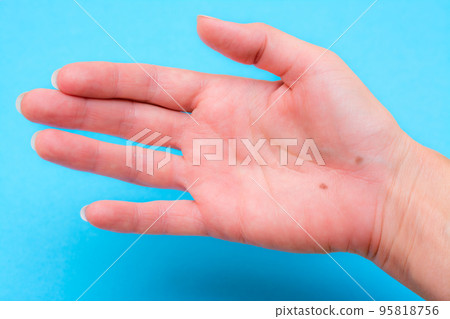Open female palm with two moles on a blue background 95818756