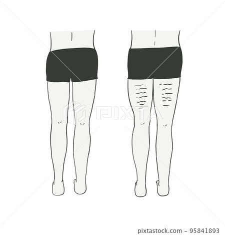 背部大腿脂肪團和美麗的大腿 95841893