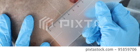 Medical worker measure with ruler mole on patient neck, man checkup birthmark in hospital Medical worker measure with ruler mole on patient neck, man checkup birthmark in hospital 95859706
