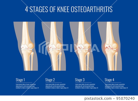 Knee joint osteoarthritis stages, medical infographics on bone cartilage arthritis, vector legs health. Knee joint osteoarthritis disease symptoms, information on knee cartilage inflammation 95870240