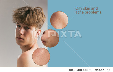 Oily skin and male problem - acne, blackhead, pustule, papule, enlarged pores. Collage with young man and facial diseases. Skincare, healthcare, dermatology, medical, beauty, health 95883078