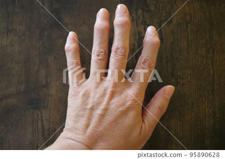 Heberden's nodule image female finger Heberden's nodule image female finger 95890628