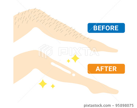 剃光腿的人的前後插圖 剃光腿的人的前後插圖 95898075