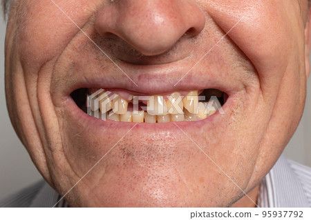 The toothless smile of an old European man on a gray background. Dentistry for pensioners, happy old age, dentist installing dentures 95937792