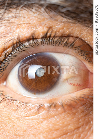 Eye of an elderly man with cataracts, clouding of the lens, macro. Eye of an elderly man with cataracts, clouding of the lens, macro. 95938670