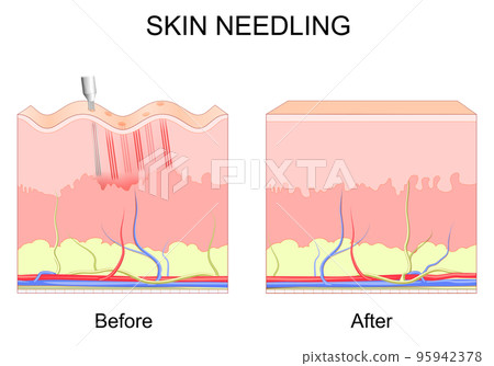 microneedling. skin needling. microneedling. skin needling. 95942378
