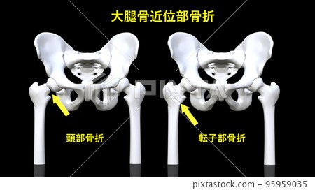 髖部骨折（帶骨盆） 95959035