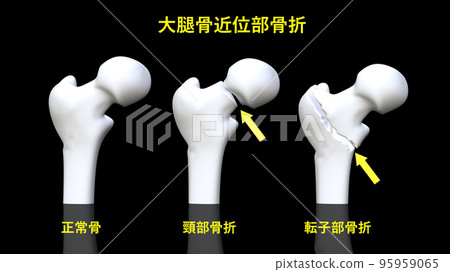 髖部骨折 95959065