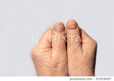 Nail fungus on the hands - dermatomicosis and onyhomicosis, comparison of healthy and sick nails. Dermatology, treatment of mycosis and skin infections. Banner copy space for text Nail fungus on the hands - dermatomicosis and onyhomicosis, comparison of healthy and sick nails. Dermatology, treatment of mycosis and skin infections. Banner copy space for text 95959407