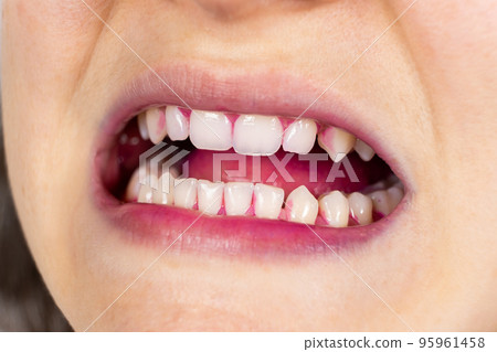 Plaque on human teeth is colored pink with indicator tablets. Plaque on human teeth is colored pink with indicator tablets. 95961458