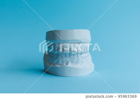 Dental plaster model of human jaw before treatment with braces Dental plaster model of human jaw before treatment with braces 95963369