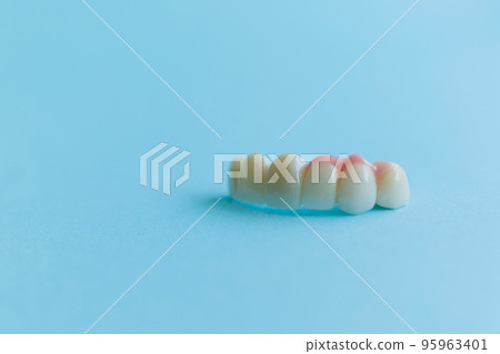 Artificial teeth on a blue background, dental crowns. Concept of dental implantation and restoration 95963401