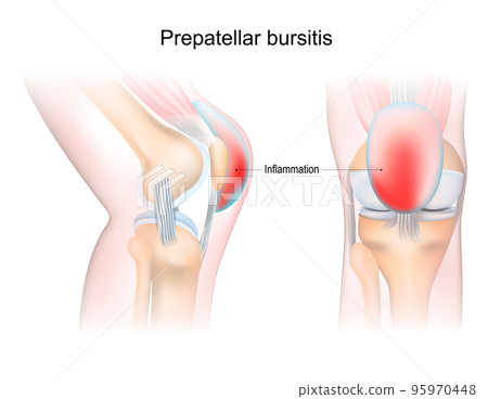 bursitis of human knee joint. Prepatellar bursitis. 95970448