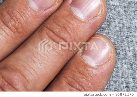 Mens fingers and nails in bad condition close up Mens fingers and nails in bad condition close up 95971170