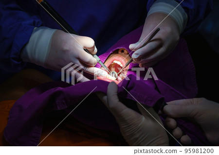 doctor cleaning the teeth patient with ultrasonic tool. Removal of tartar and plaque, prevention of dental disease paradontitis. doctor cleaning the teeth patient with ultrasonic tool. Removal of tartar and plaque, prevention of dental disease paradontitis. 95981200