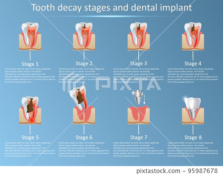Tooth decay stages and dental implant vector illustration Tooth decay stages and dental implant vector illustration 95987678