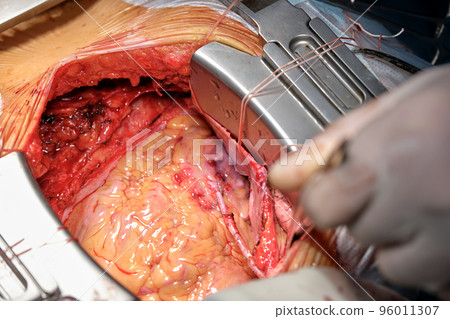 Closeup of professional doctor hands operating a patient during open heart surgery in surgical room. Healthcare and medical intervention concept Closeup of professional doctor hands operating a patient during open heart surgery in surgical room. Healthcare and medical intervention concept 96011307