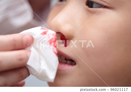 Elementary school girl with nosebleed (image with blood) 96021117