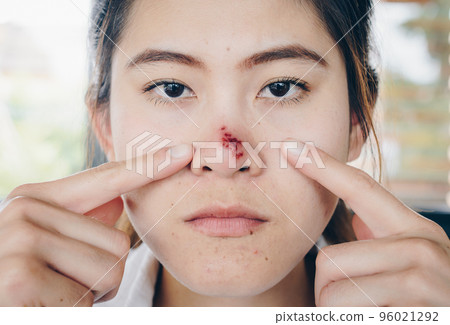 The Herpes simplex on asian woman nose, Herpes simplex is a viral disease caused by the herpes simplex virus. Infections are categorized based on the part of the body infected. The Herpes simplex on asian woman nose, Herpes simplex is a viral disease caused by the herpes simplex virus. Infections are categorized based on the part of the body infected. 96021292