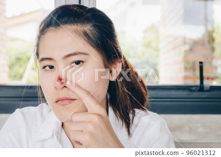 The Herpes simplex on asian woman nose, Herpes simplex is a viral disease caused by the herpes simplex virus. The Herpes simplex on asian woman nose, Herpes simplex is a viral disease caused by the herpes simplex virus. 96021312