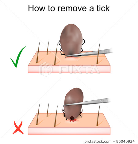 How to remove a tick. mite Removal. 96040924