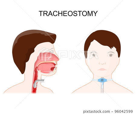 Tracheotomy. side view of the neck and placement of a tracheostomy tube Tracheotomy. side view of the neck and placement of a tracheostomy tube 96042599