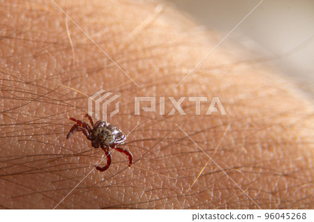 Crawling deer tick on the background of human hairy skin. Dangerous insect infects with disease 96045268
