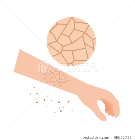 dry and cracked skin 96061735