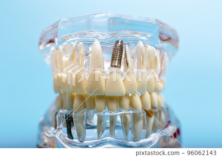 Compare tooth model and tooth model with metal wire dental 96062143