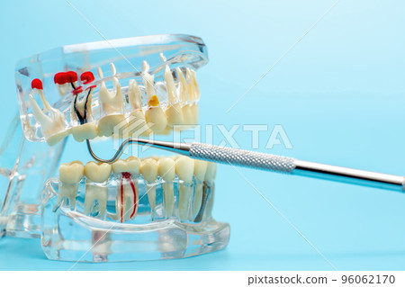 Compare tooth model and tooth model with metal wire dental Compare tooth model and tooth model with metal wire dental 96062170