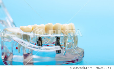 Dentist dental prosthetic teeth, gums, roots close-up. Studying dental diseases concept 96062234