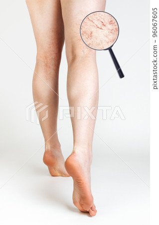 The concept of varicose veins and cosmetic treatment. Female legs with vascular asterisks. Magnified image of blood vessels. Rear view. White background. Vertical 96067605