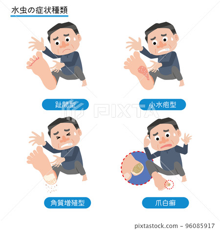 一個被腳氣症狀困擾的男人 96085917