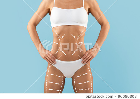 Liposuction Treatment. Slim Young Female Body With Drawn Lifting Up Lines 96086808