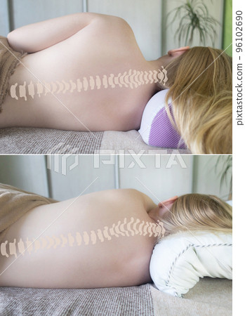 Before and after. Concept photo. Curvature of the spine due to incorrect position during sleep. How an orthopedic pillow changes the position of the vertebrae. Correction of squeezing of nerve endings Before and after. Concept photo. Curvature of the spine due to incorrect position during sleep. How an orthopedic pillow changes the position of the vertebrae. Correction of squeezing of nerve endings 96102690