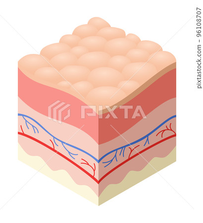 Skincare medical concept. Problems in cross-section of human skin horizontal layers structure. Anatomy illustrative model unhealthly layer of skin 96108707