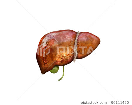 Realistic illustration sick cirrhosis human livers, damaged liver, excessive drinking of alcohol, treatment Realistic illustration sick cirrhosis human livers, damaged liver, excessive drinking of alcohol, treatment 96111430