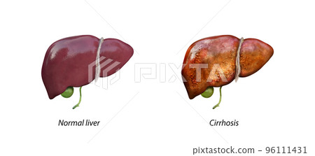 Normal liver versus liver with Cirrhosis, damaged liver, excessive drinking of alcohol, treatment, 96111431