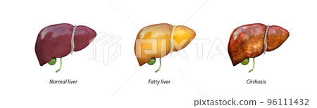 Normal liver versus liver with Cirrhosis, damaged liver, excessive drinking of alcohol, treatment, Normal liver versus liver with Cirrhosis, damaged liver, excessive drinking of alcohol, treatment, 96111432
