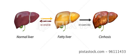 Normal liver versus liver with Cirrhosis,... - Stock Illustration ...